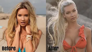 My Lip Injection Journey - Why I Do It A Different Way