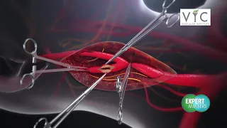 Expert Answers Vascular Institute of Chattanooga - Carotid Artery Disease