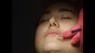 BuzzFeed vs Today My Lip Injection Story