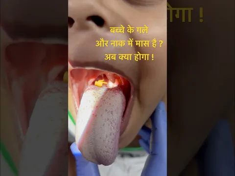 गले में मास और नाक में मास है ? अब क्या होगा ! #epiglottis #turbinate #tastebuds #information #gyan