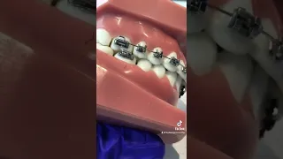 Trouble shooting braces long wire