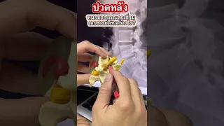  อาการปวดหลังและชาลงขาเกิดจากสาเหตุอะไร 