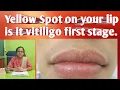 Yellow Spot on lip like pimple what is it All about yellow spot on lip is it 1st stage of vitiligo