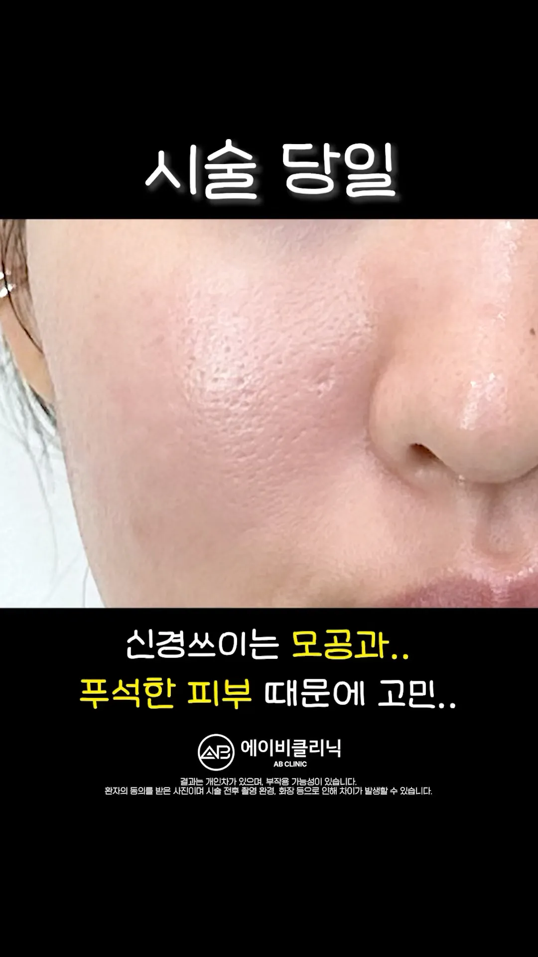 동굴 모공 포텐자로 정리하기 💕