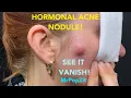 Very full hormonal acne pocket of Purulence I drain it Instant relief and resolved in 48 hours