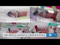 Australian mother gives birth to rare identical quadruplets The Daily Brew