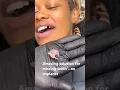 Amazing solution for missing teeth No implants and you can eat with it