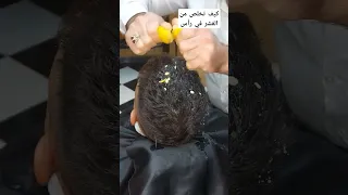 ليمون حل الواحد لخلص من القشره رأس 