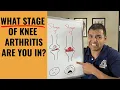 How To Clearly Tell Where You Are In The 4 Stages Of Knee Arthritis