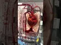 Download Lagu Donation after circulatory death (DCD) heart transplant