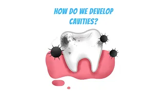 How cavities develops from Tooth decay 3D animation
