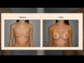 Dr Rocheford Breast Augmentation Before After Photo Images