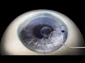 Download Lagu (DMEK) Descemet's membrane endothelial keratoplasty animation