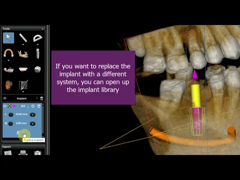 Video thumbnail: 3D imaging software for implant planning (Carestream)