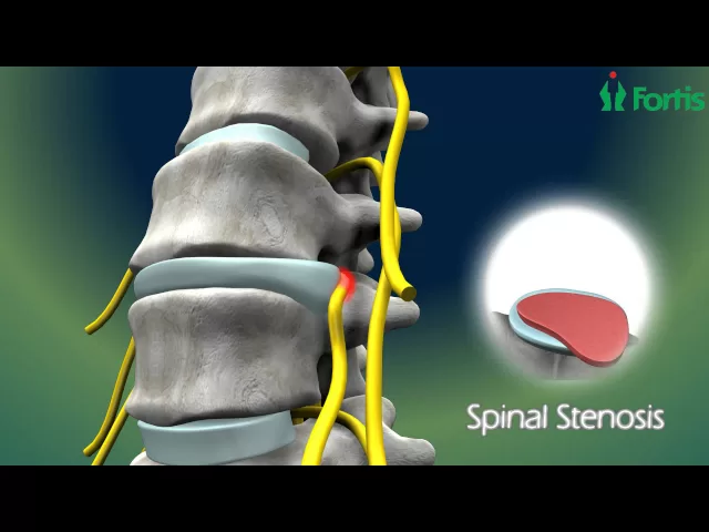 Micro Lumbar Discectomy & Fusion ( Spine Surgery) Neuro Surgery; Fortis Healthcare,India