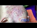 ACNE TREATMENT FOR Manh part 4 64 Loan Nguyen