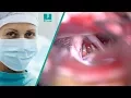Download Lagu Koagulasi di belakang ICA Menggunakan SuperGliss® Non-stick TEO Bipolar Forceps I Charlie Teo, MD
