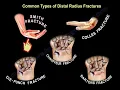 Download Lagu Distal Radius Fracture Types, diagnosis, and treatment.