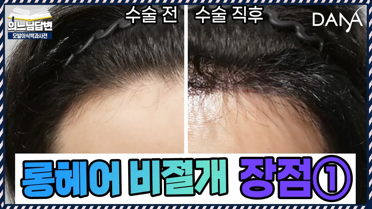 의느님답변📂모발이식 후 다음 날 일상생활 가능한 ‘롱헤어 비절개’ㅣ롱헤어 비절개 장점과 단점①ㅣ다나성형외과(DANA)ㅣ모발이식ㅣ헤어라인교정ㅣ두피문신ㅣ탈모치료