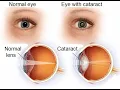 Removal of intraocular lens CPT code - simplify medical coding