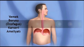 İleri Düzey Endoskopi ile Erken Evre Yemek Borusu Kanseri Tespiti ve Ameliyatsız Olarak Çıkartılması. 