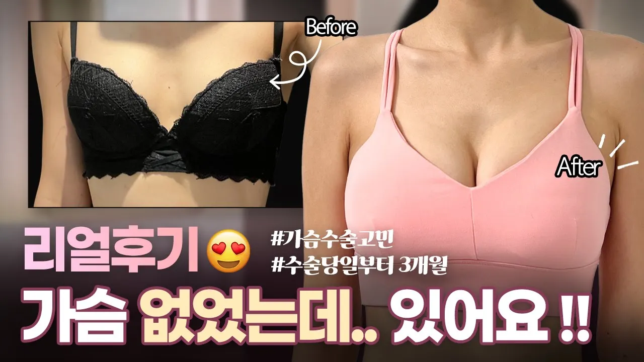 결국 했어요🙋🏻♀️ 가슴수술 당일부터 3개월까지 l 얼굴도 예쁜데 다 가져가야 했냐♥