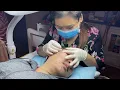 487 Blackheads Acne treatment 2022