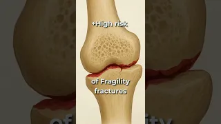 Osteopenia T-score 0 to - 2 5 Osteoporosis below