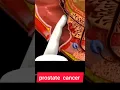 Download Lagu PROSTATE  CANCER  || PROSTATE CANCER ANIMATION  #howtogetsuccessinlife #biologyislife #getsuccess