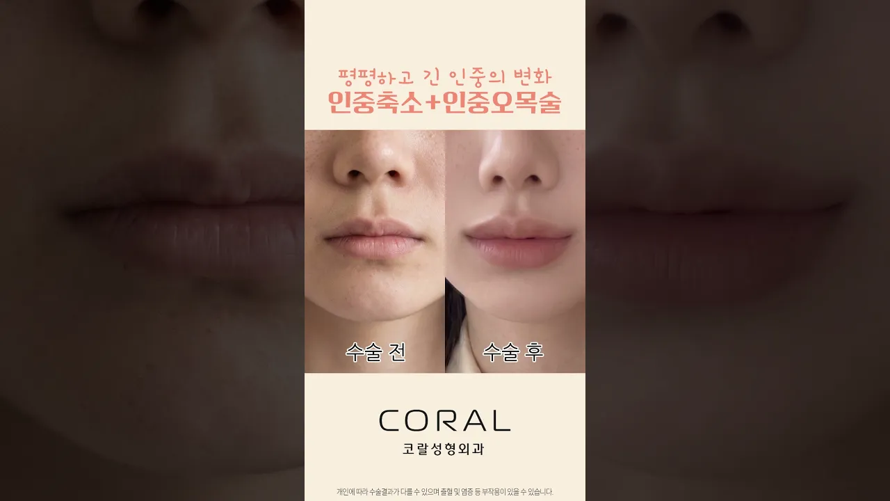 1mm 차이로 중안부 삭제하는 법 ✨ 인중축소+오목술 #shorts #인중축소