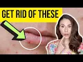 HOW TO GET RID OF LIP PIMPLES FAST Dermatologist
