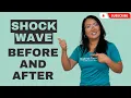Before and After ShockWave Treatment