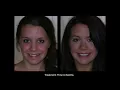 How Does Rapid Orthodontics Work Adult Invisalign Alternative