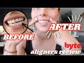 BYTE ALIGNERS REVIEW progress byte aligners before after