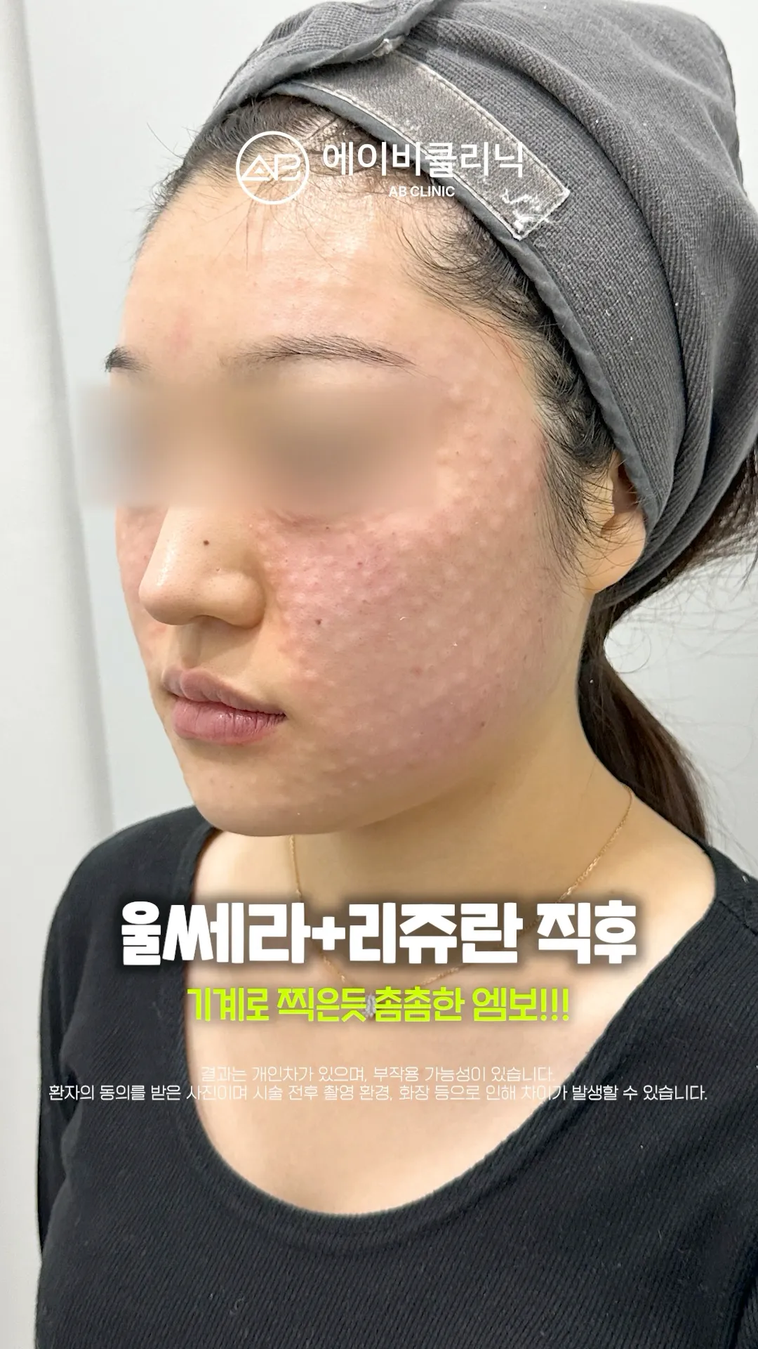 울쎄라+리쥬란 시술 직후