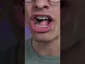 1 month of braces