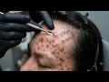 Loan Nguyen Acne Treatment 31zz