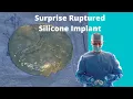Download Lagu Silicone Breast Implant Rupture Discovered During Breast Augmentation Surgery