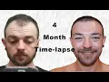 Lagu Hair Transplant Time-lapse 0-4 months