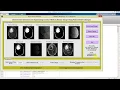 Brain Tumor Detection Watershed Technique Matlab Project with Source Code