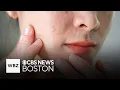Popular weight loss drugs may trigger acne in women researchers say