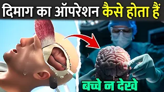 दिमाग का ऑपरेशन कैसे होता है | How Does Brain Surgery Work
