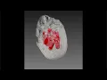Intracranial Hemorrhage and Edema Segmentation Using Deep Learning - by RSIP Vision