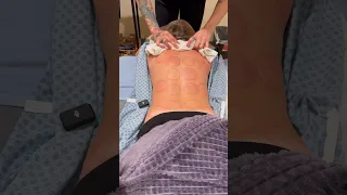Fire Cupping ASMR