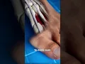 Download Lagu Bunion Correction 😨 (explained)