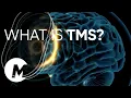 Lagu What is TMS? How does TMS work? MagVenture TMS Therapy