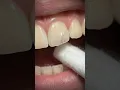 Watch How a Dentist Rebuilds a Chipped Front Tooth Using Modern Composite Bonding Techniques