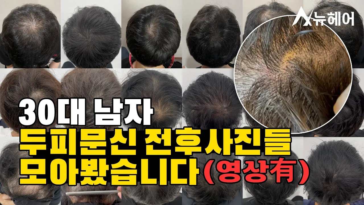 30대 남자 탈모 두피문신 전후사진들ㅣ정수리탈모