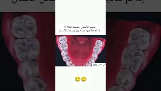  صرير الأسنان  سحل طبيبة اسنان  قناة تعليم أون لاين  ابتسامةهوليود  فينير  انحسار  لثة  عظمة  متابعي دندنها