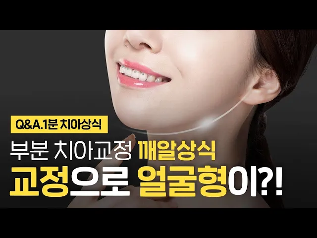 치아교정으로 얼굴형이 변한다?! 부분 치아교정 얼굴변화? ⏰1분 치아상식!!